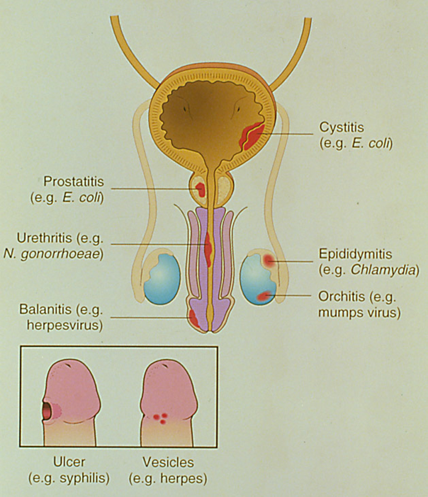 Prostatitis balanit)