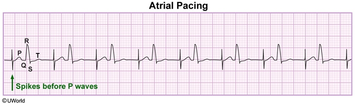 Cardiac Ecgs Flashcards Memorang